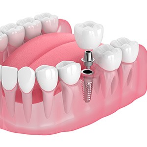 Illustration of single dental implant