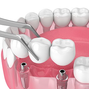 Illustration of implant bridge