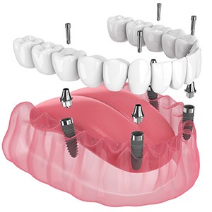 Illustration of implant denture