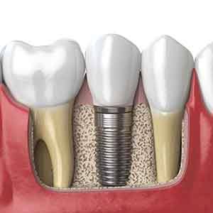 A 3D illustration of a placed dental implant