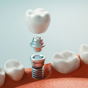 diagram showing the part of a dental implant