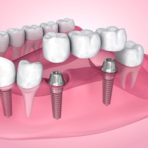 diagram of a bridge being attached to dental implants