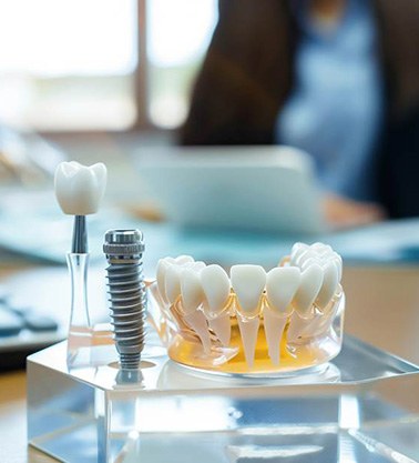 Dental implant and calculator