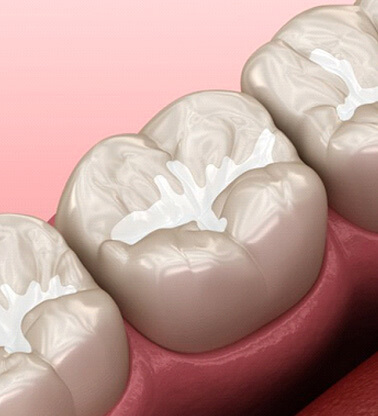 a 3D illustration of teeth with dental sealants